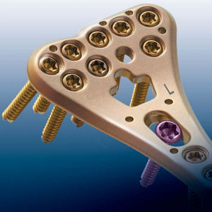 plaque de compression de radius