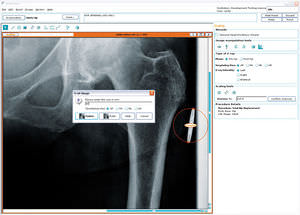 logiciel pour chirurgie de la hanche