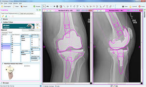 logiciel pour chirurgie du genou