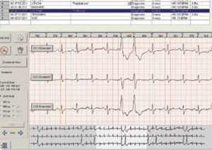 logiciel pour Holter cardiaque