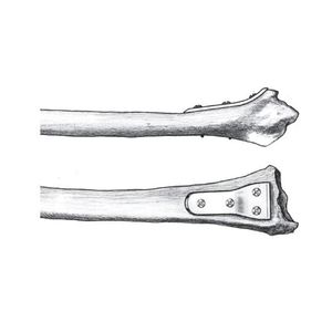 plaque de compression de radius