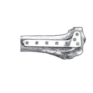 plaque de compression de tibia
