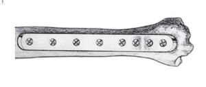 plaque de compression de tibia