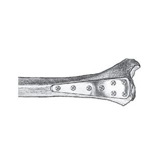 plaque de compression de tibia