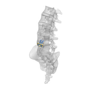 cage intersomatique thoraco-lombaire