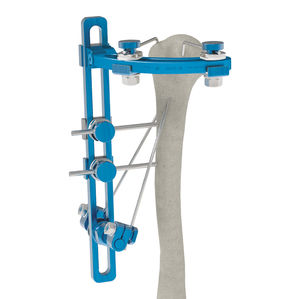 fixateur externe humérus