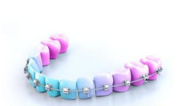 Lot De 10 Fils D'arche Orthodontiques Cu-Niti - Forme Rectangulaire Damon, Alliage Cuivre-nickel-titane