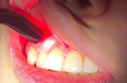 Clé De Couple Dentaire Autoclavable Easyinsmile - Pour Pièces à Main NSK/DT/EMS/Pic, Pointe échelle