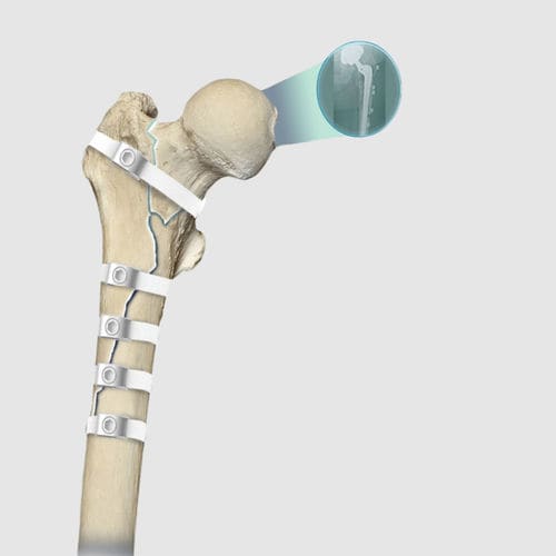 fil de cerclage orthopédique pour révision de prothèse de hanche - Ortolog Medikal