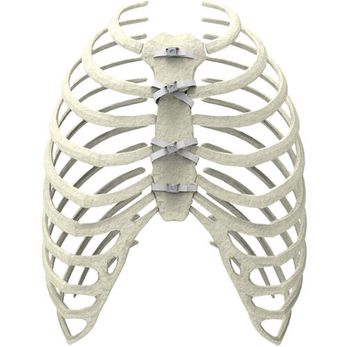 fil de cerclage orthopédique pour fermeture sternale - Ortolog Medikal