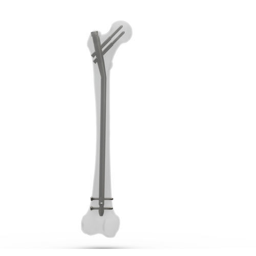 Clou intramédullaire fémoral - FN2 series - TASARIMMED - fixation proximale / fixation distale / droit