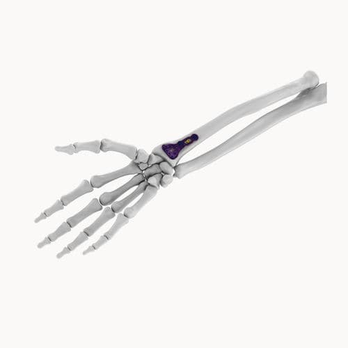 Plaque de compression de radius - EDR series - Eonex Medical - distale / verouillée / non verrouillée