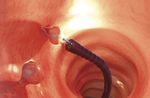 panier endoscopique pour extraction de polypes intestinaux