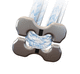 bouton de suture pour reconstruction du ligament acromio-claviculaire