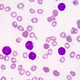 kit de test de leucémie aiguë lymphoblastique / d'oncologie / pour médecine de précision / génétique