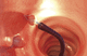 panier endoscopique pour extraction de polypes intestinaux / droit