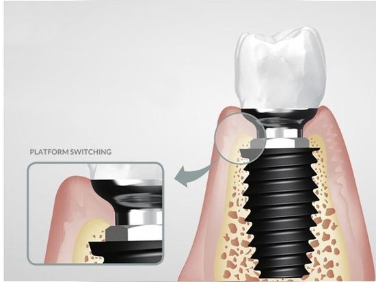 La société Korea Dental Implant (KDI) Inc a présenté son système d'implant SLOCK.