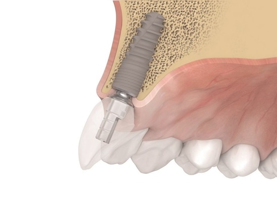 Le tioLogic TWINFIT de Dentaurum