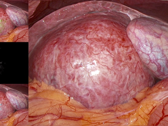 série 214K Système d'imagerie endoscopique par fluorescence FloNavi® 4K