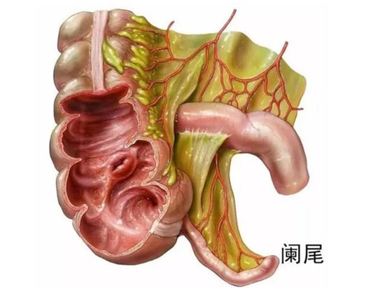 L'appendice peut non seulement s'enflammer, mais aussi subir des modifications cancéreuses ! Il peut représenter un risque mortel similaire à celui du cancer colorectal.