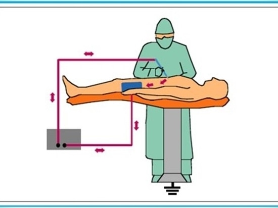 Le concept de la chirurgie HF monopolaire