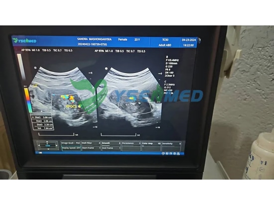 L'échographie Doppler couleur portable YSENMED YSB-M5 fonctionne bien dans un hôpital zimbabwéen.