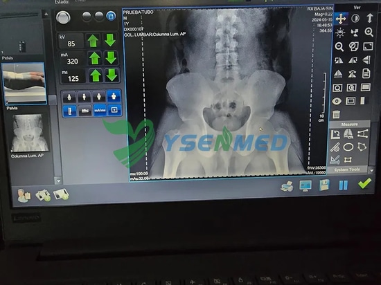 Un radiologue mexicain est satisfait du système de radiographie numérique portable YSENMED YSX056-PE