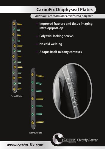 CarboFix Diaphyseal Plates