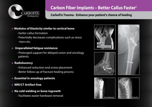 CarboFix "Piccolo" Distal Radius Plates