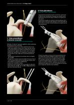 TECHNIQUE OPERATOIRE - LATARJET BANKART - 4