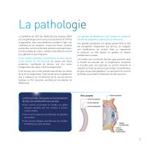 Traitement technologique du syndrome de l'oeil sec MGD - 3