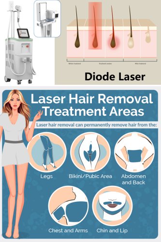 1200W diode laser hair removal machine. Professional laser hair removal machine commercial. The best laser hair removal machine brand-BVLASER.