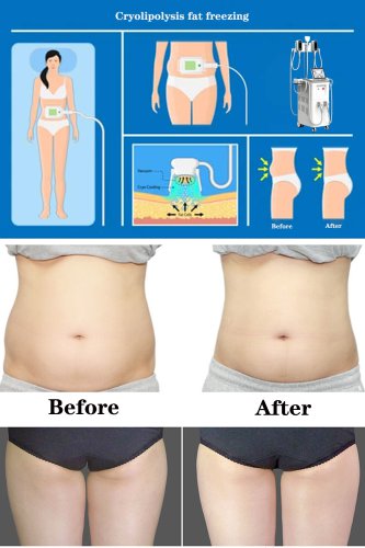 360 cryolipolysis machine professional cryolipolysis slimming machine