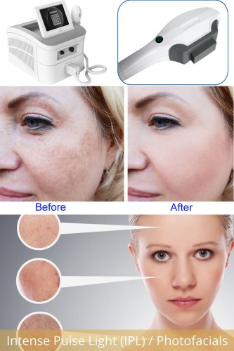 best professional IPL machine for skin rejuvenation