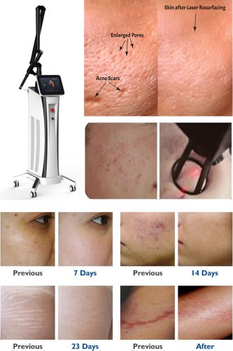 CO2 fractional laser resurfacing dermatology CO2 laser machine