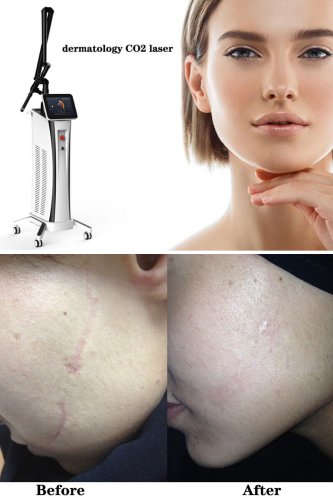 co2 laser skin resurfacing machine dermatology acne scar fractional co2 laser