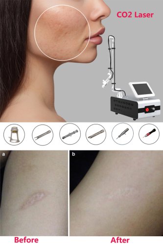 CO2 laser skin resurfacing machine portable CO2 fractional laser machine