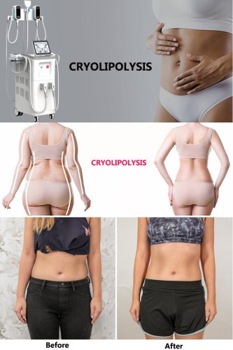 cryo slimming machine cryolipolysis fat freezing slimming machine