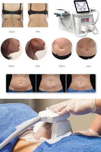 Cryolipolysis fat freeze slimming machine. FDA approved. Best professional cryolipolysis machine manufacturer.