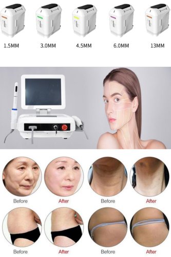 HIFU high intensity focused ultrasound for face lifting