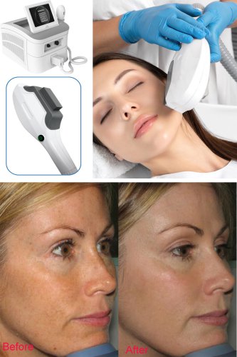 IPL machine for skin rejuvenation