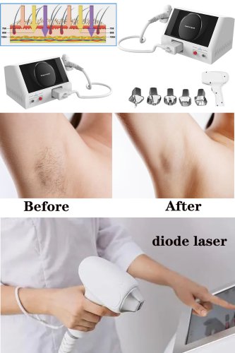 medical grade laser hair removal machine most effective diode laser hair removal machine professional