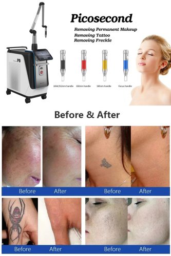 OEM picosecond laser machine-BVLASER. CE certification picosecond laser tattoo removal machine. High power picosecond laser.