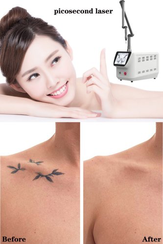 picosecond aesthetic laser picosecond laser tattoo removal machine