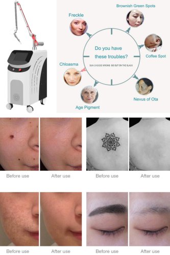 picosecond laser scar removal OEM picosecond laser machine