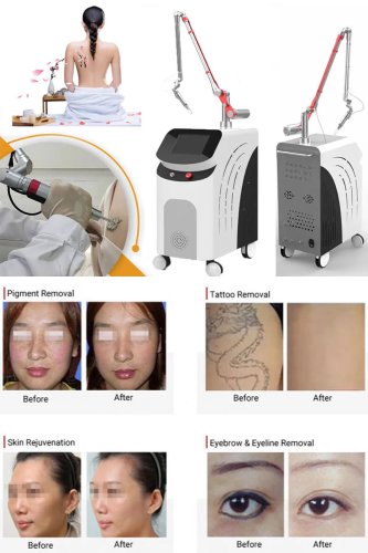 picosecond laser tattoo removal machine picosecond aesthetic laser for pigmentation