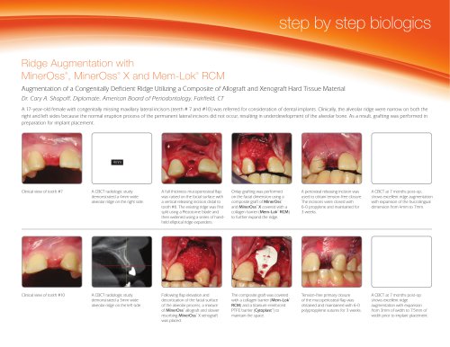 Ridge Augmentation with MinerOss, MinerOss X and Mem-Lok RCM