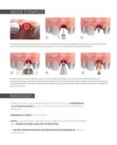 BTI Extracteur Radiculaire - 3