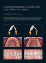 Traitement Peu invasif avec des facettes Prettau®SKIN ® Prettau® 3 Dispersive® 3 Dispersive® - 3