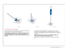 COTYLE A DOUBLE MOBILITE - 5